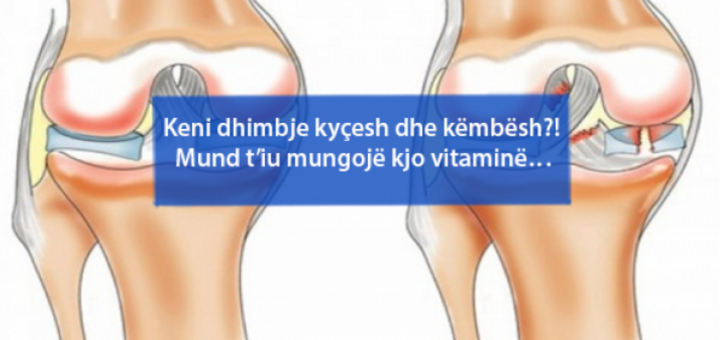 Keni dhimbje kyçesh dhe këmbësh?! Mund t’iu mungojë kjo vitaminë…