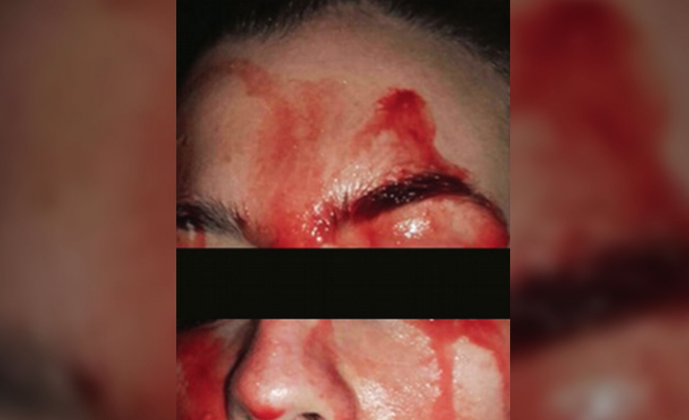 SEMUNDJE E RRALLE/ Gruaja djersin gjak nga fytyra dhe duart! (Foto)