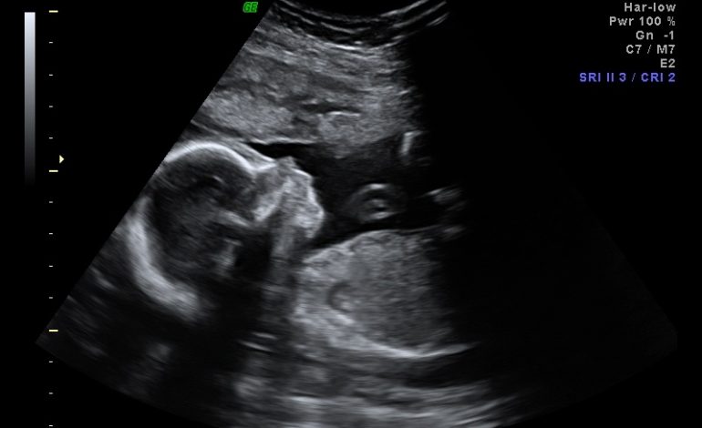 Në eko panë një masë të çuditshme, nëna refuzoi të abortojë dhe ndodh e pabesueshmja