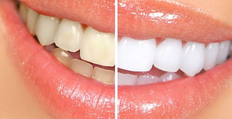 Lamtumirë dentist/ Zbardhini dhëmbët tuaj menjëherë me këtë përbërës