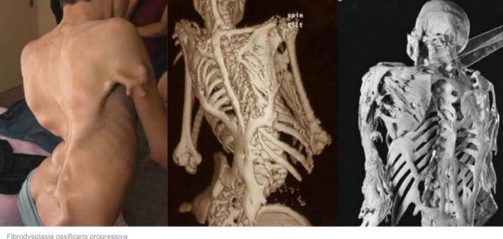 Sëmundja e rrallë që muskujt i kthen në kocka (FOTO)