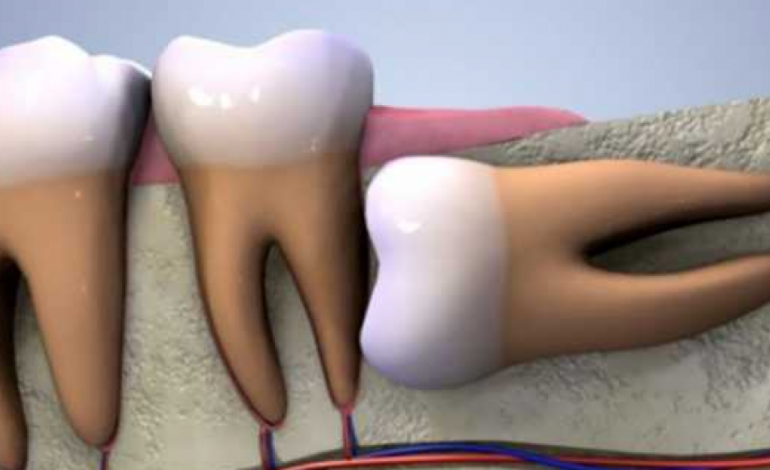 A duhet ti heqim dhëmballët e pjekurisë? Ja çfarë thonë dentistët