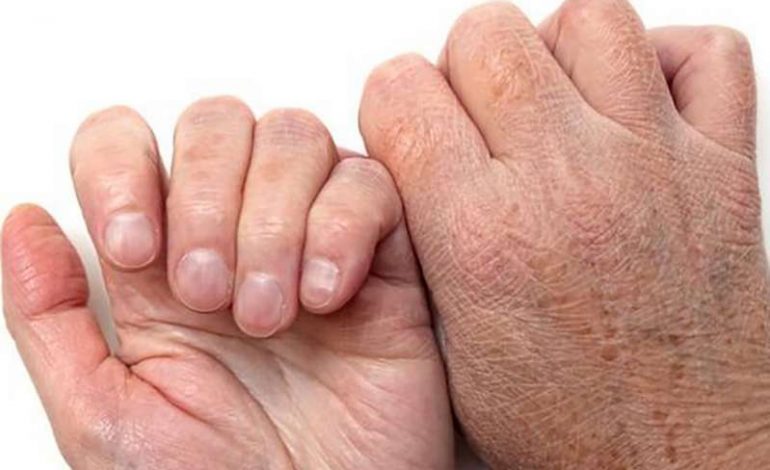 Keni lëkurë të thatë? Këto janë 4 sëmundjet të cilave duhet t’i kushtoni vëmendje