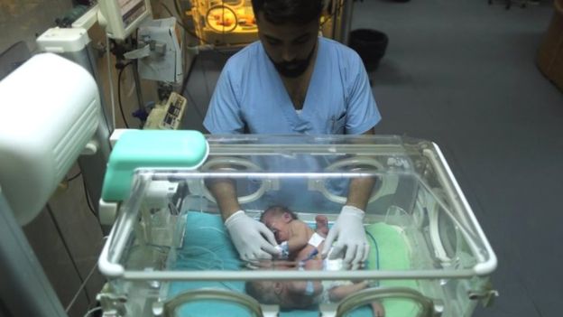 Mrekullitë ekzistojnë! Binjaket e porsalindura me organe të ngjitura i mbijtojnë kirurgjisë së ndarjes (FOTO)