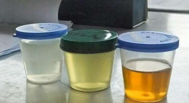 Çfarë tregon ngjyra e urinës për problemet e trupit tonë