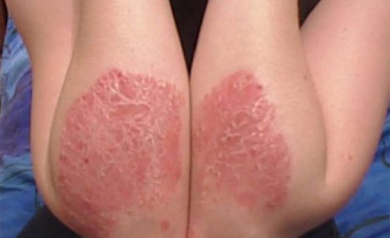 5 mënyra sesi të hiqni qafe vetë, njëherë e mirë psoriazisin!