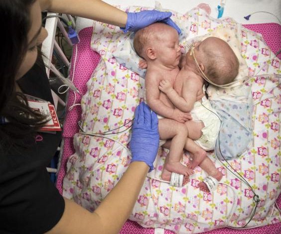 Foshnjat binjake të bashkuara në zemër, ndahen me sukses (Foto)
