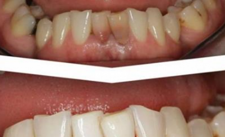 Pastroni dhëmbët me këtë përbërës dhe mos shkoni më tek dentisti
