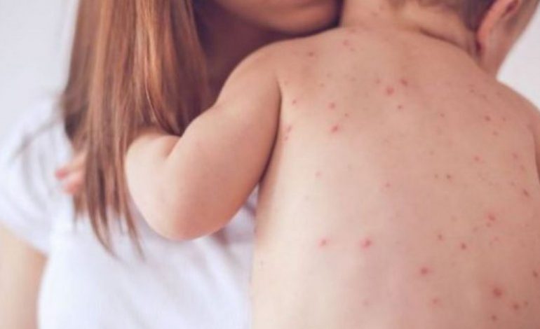 SEMUNDJA E FRUTHIT/ Ministria e Shëndetësisë në gatishmëri, masat për parandalimin dhe eleminimin e epidemisë