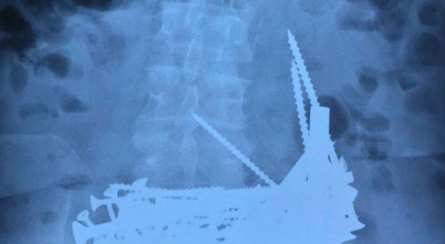 FOTO+VIDEO/ Sapo i panë stomakun ruses, kirurgët bënë një operacion emergjent: I gjetën 150 gozhda, por s’ishin vetëm ato