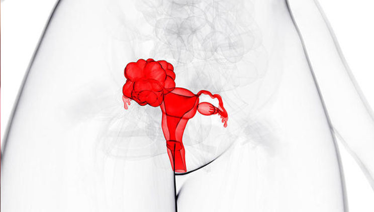 Endometrioza, shkaku kryesor i infertilitetit, ja 5 shenjat më të zakonshme të kësaj sëmundjeje