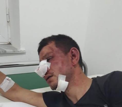 DETAJE TË REJA/ Me hundë e dhëmbë të thyer, si duket një ditë pas arrestimit i riu që qëlloi me armë në Vlorë (FOTO)