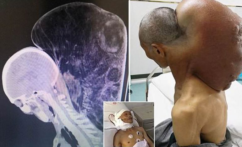 50 vite neglizhencë, heq nga trupi 15 kg tumor