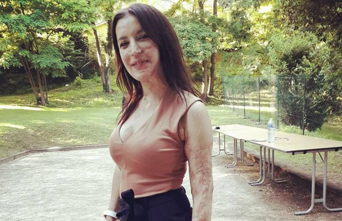 E sulmuan me acid në fytyrë, 31-vjeçarja nga Vlora publikon fotot dhe jep një mesazh