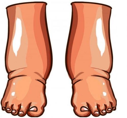 Mbajtja e ujit në trup shkakton shumë sëmundje: Ja si ta mënjanoni këtë gjë