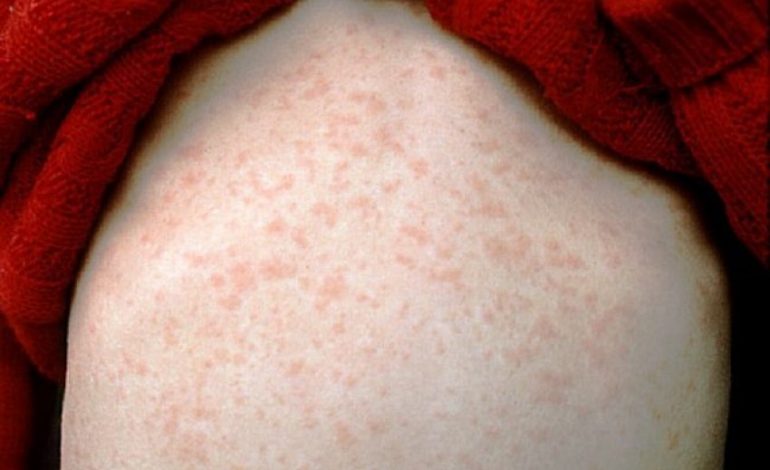 SITUATA/ 51 të prekur nga fruthi, ISHP bën apel: Vaksinoni fëmijët
