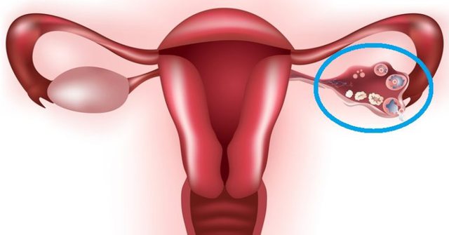 NË MËNYRË NATYRALE/ 9 trajtime në kushte shtëpie që shpërthejnë cistet ovariane