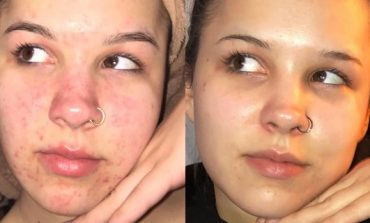 MËSOJINI TANI/ 3 mënyrat më efektive për të kuruar të gjitha llojet e akneve në fytyrë