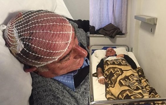 ATË E BIR DHUNUAN ISH-ZV.DEKANIN/ Gruaja: E masakruan, 9 qepje në kokë. Ja pse nisi sherri
