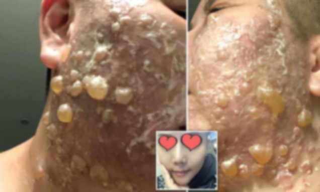 KOLAGJENI I DËSHIRUAR TEK NJË 50 VJEÇARE/ Kirugjia plastike i shkatërron fytyrën, një orë më pas… (FOTOT)