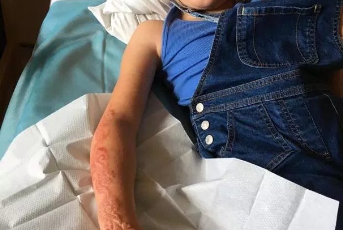 E DHIMBSHME/ Vogëlushja humb lëkurën nga tatuazhi i përkohshëm (FOTO)