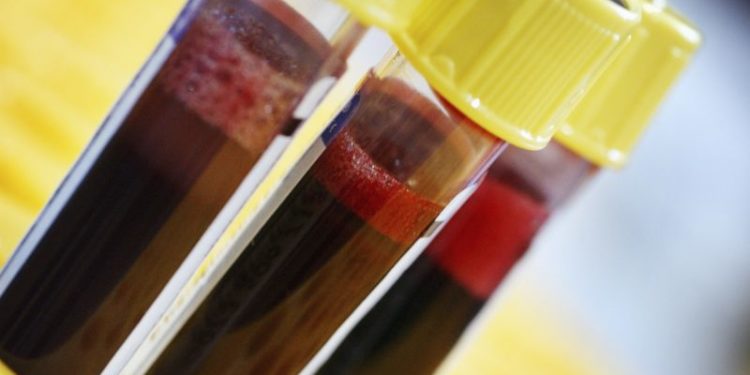 ZBULIMI I RI/ Shkencëtarët parashikojnë vdekjen përmes analizave të gjakut
