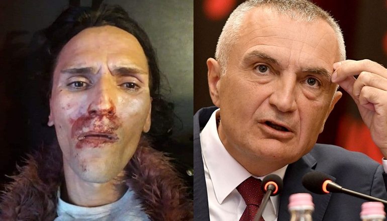 DHUNIMI I TRANSGJINORES ANXHELA/ Reagon Meta: Sulm burracak, autorët të dalin para drejtësisë