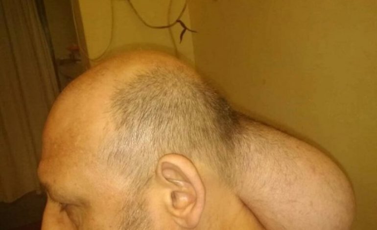 KUJDES! PAMJE TË RËNDA/ I dënuari në burgun grek me një “kokë të dytë” falë dhunës së policisë (FOTO)
