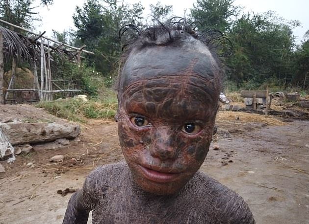 SËMUNDJA E RRALLË E PASHËRUESHME/ Njihuni me 10-vjeçarin që ka trupin si “gjarpër”. Lahet çdo dy orë… (FOTO)