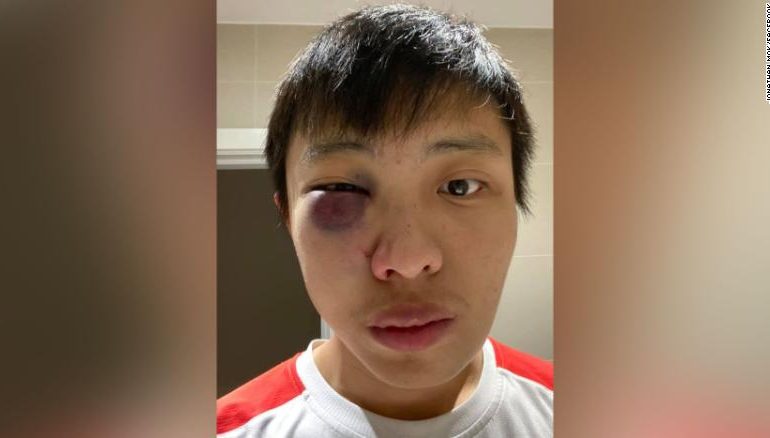 “NUK DUA KORONAVIRUS NË SHTETIN TIM”/ Sulm racist studentit kinez në Angli (FOTO)