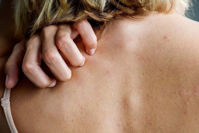 A JANË ACARIMET E LËKURËS SHENJA TË PREKJES NGA COVID? Ja çfarë thotë dermatologia e huaj