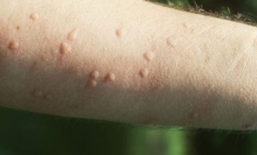 LUFTA KUNDËR KORONAVIRUIST/ Dermatologët: Nëse keni këtë shenjë në lëkurë, mund të jeni me COVID-19