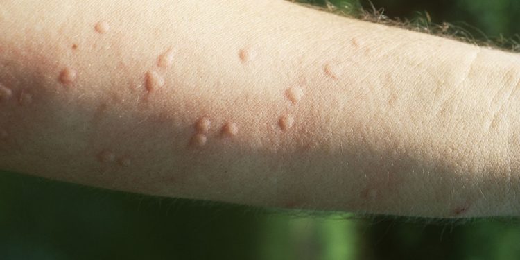 LUFTA KUNDËR KORONAVIRUIST/ Dermatologët: Nëse keni këtë shenjë në lëkurë, mund të jeni me COVID-19