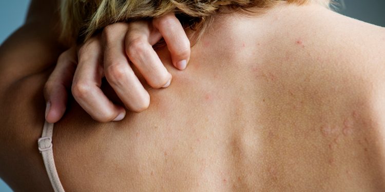 “RASTET…”/ Flet mjekja e lëkurës: Koronavirusi jep shenja, dermatologët në alarm
