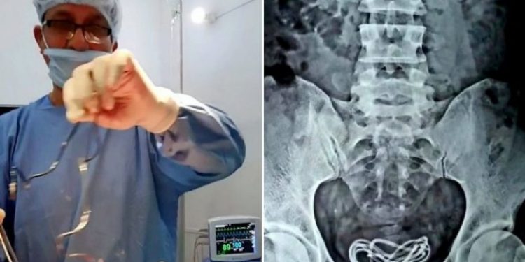 E PABESUESHME/ 30-vjeçari gëlltiti karikuesin e telefonit, mjekët ia heqin nga trupi (FOTOT)