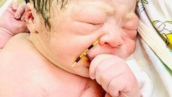 E PABESUESHME/ Nëna përdori kontraceptiv për të mos mbetur shtatzënë, foshnja lind duke e mbajtur spiralen në dorë