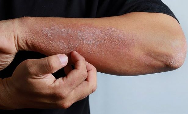 SKUQJA DHE IRRITIMI I LËKURËS/ Simptomë e prekjes nga COVID-19