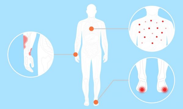 BËNI KUJDES! Këto janë 8 simptomat e lëkurës tek pacientët me koronavirus