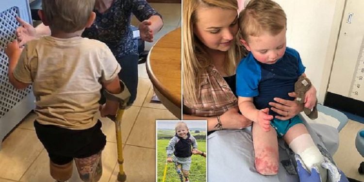 PREKËSE/ Humbi të dyja këmbët, momenti kur 4-vjeçari ecën për herë të parë me… (VIDEO+FOTOT)