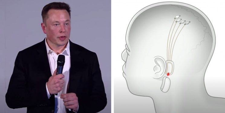 “ÇIPI MONEDHË”/ E prezanton Elon Musk: Instalohet në tru dhe mund të shërojë verbërinë, paralizën apo parkinsonin