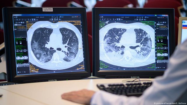 ALARMI/ Organet që dëmton koronavirusi te personat që e kalojnë pa simptoma