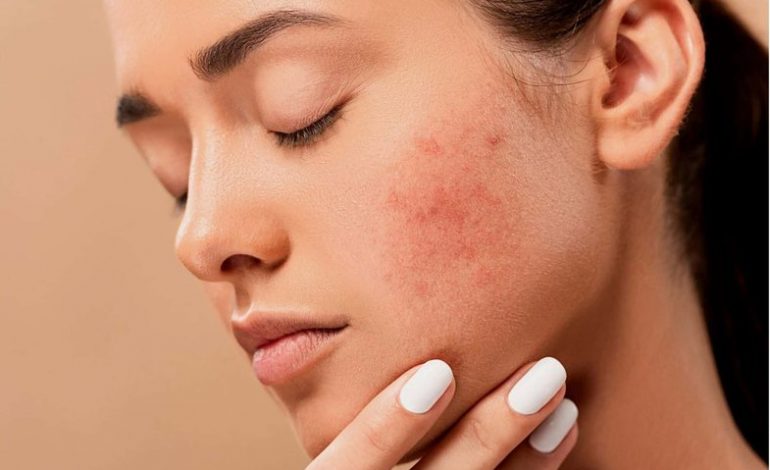 ÇRREGULLIMET HORMONALE/ Simptomat për gratë, burrat dhe fëmijët