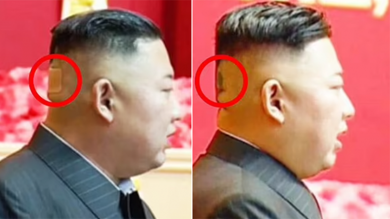 A ËSHTË SËMURË? Kim Jong-un shfaqet me një njollë të zezë prapa koke, qytetarët në dëshpërim të thellë