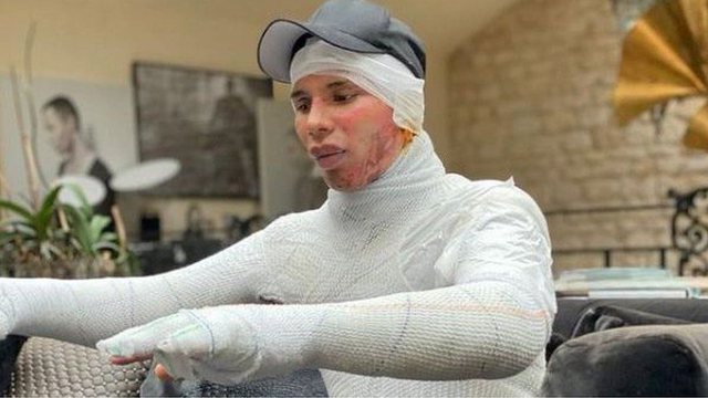 “OXHAKU SHPËRTHEU”/ Stilisti i famshëm nxjerr foton horror, shfaqet i fashuar nga koka tek këmbët (FOTOT)