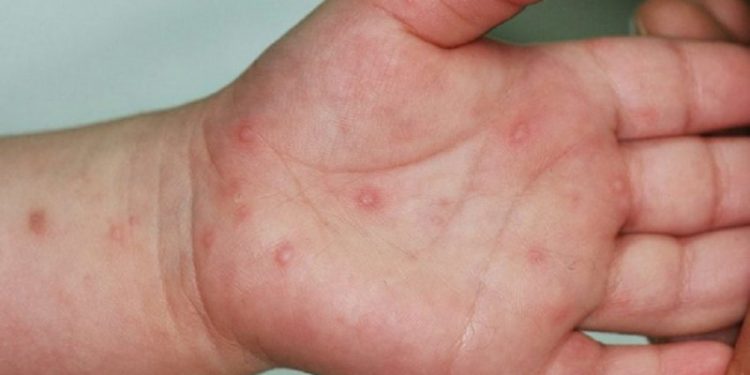 SËMUNDJA PREJ KOHËSH NË SHQIPËRI/ Mjeku Alimehmeti: Nuk ka mjekim, mbajini fëmijët në shtëpi