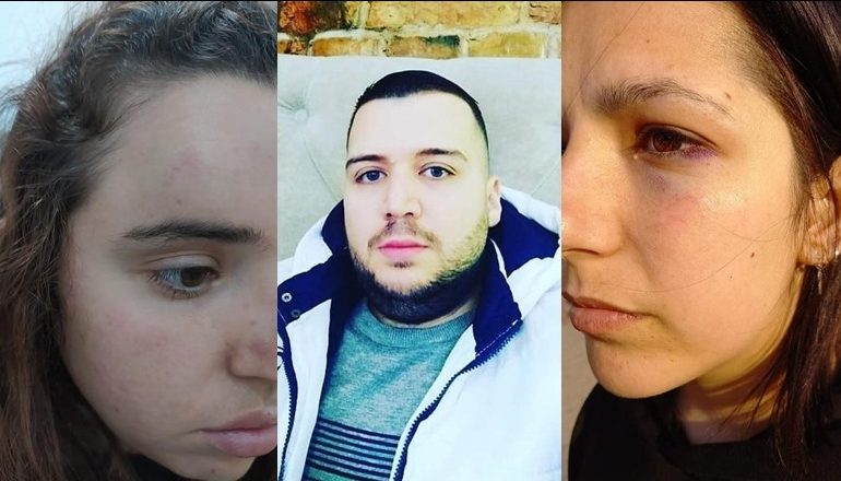 ISHTE KTHYER NË TMERR PËR VAJZAT/ Arrestohet 30-vjeçari, rrahu me grushte dy të rejat në mes të ditës në Tiranë