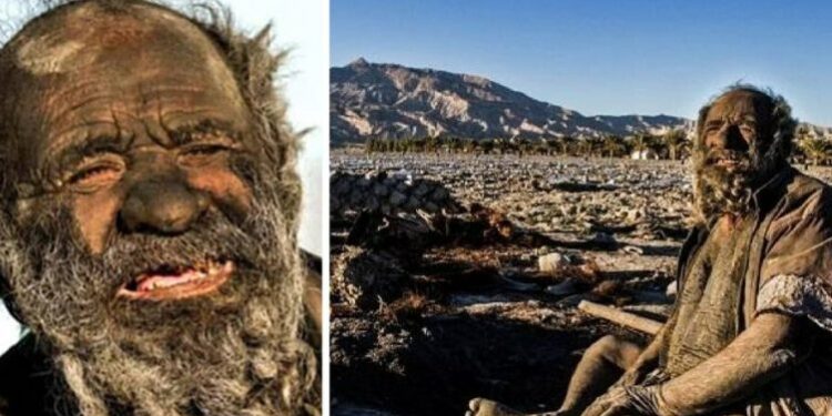 70 VITE PA U LARË/ Njeriu më i pisët në botë habiti mjekët që e ekzaminuan
