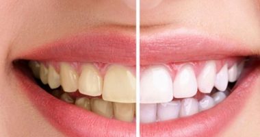 HARROJENI DENTISTIN DHE KURSENI PARA/ Si të zbardhni dhëmbët në kushte shtëpie