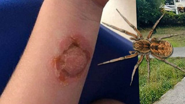 MERIMANGA HELMUESE NË BERAT/ Shtohen rastet nga pickimi i “vejushës së zezë”