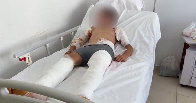 E RËNDË/ U sulmua nga 6 qen, pamjet e djalit 12 vjeçar në spital, i fashuar duar e këmbë